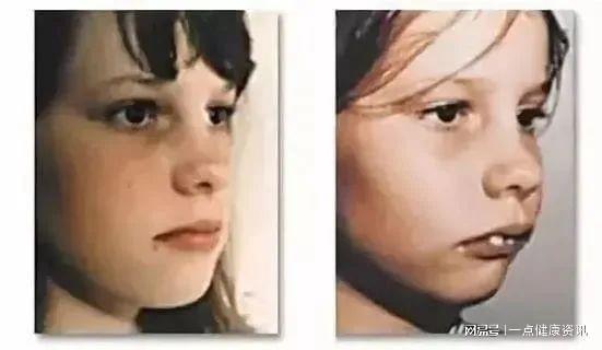 成人改鼻子呼吸视频,成人鼻整形手术全解析